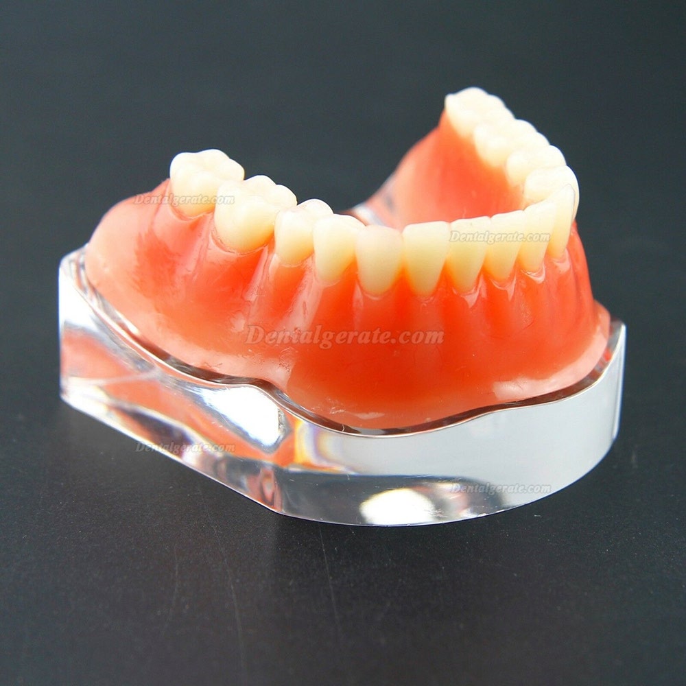 Dental Overdenture Typodont Modell Minderwertiges Pr&auml;zisionsimplantat Golden 6009